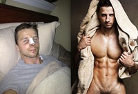 Simon Dexter Porn simon shocking before after pics gay porn star turned male escort dexters nose